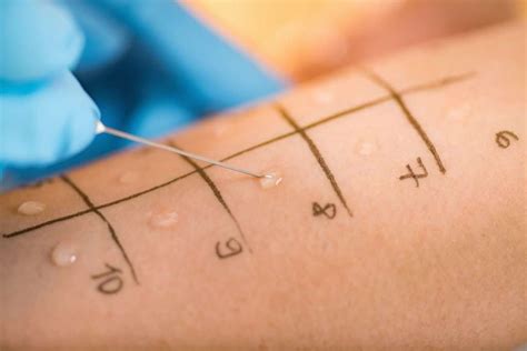 scratch test vs intradermal|Allergy Testing .